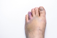 Psychological Impact of a Broken Toe on Athletes