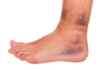 What Can Cause Ankle Pain?