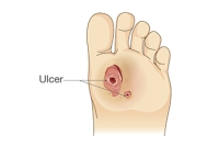 Causes and Risks of Diabetic Foot Ulcers